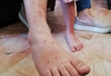 Tabasco enfrenta aumento de casos de varicela.