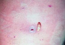 Salud Tabasco intensifica campaña preventiva contra el gusano barrenador en humanos.