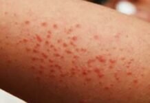 México rebasa los cinco mil casos de sarampión; Tabasco bajo vigilancia sanitaria.