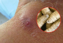 Segundo caso de miasis humana en Tabasco confirmado.