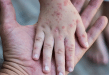 Aumentan a 19 casos de sarampión en Tabasco y sube ranking nacional.