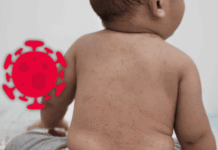 Sarampión en Tabasco suma 21 casos confirmados oficiales.