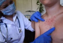 Detectan más casos de sarampión y refuerzan vigilancia sanitaria.