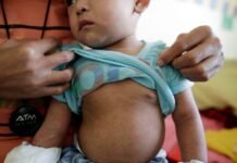 Salud reporta sarampión controlado en Tabasco durante enero.