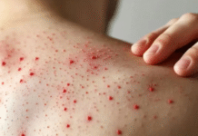 Confirman 33 casos de sarampión en Tabasco.