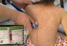 Casos de sarampión superan nueve mil en México.