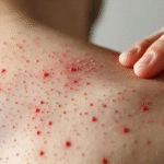 Confirman primera muerte por sarampión en Chiapas.