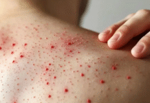 Confirman primera muerte por sarampión en Chiapas.