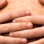 Tabasco registra 50 casos confirmados de sarampión.