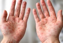 Aumentan 29 casos de sarampión y refuerzan vacunación estatal.