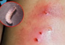 Confirman nuevo caso de miasis humana en Tabasco.