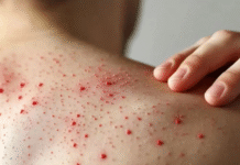 Tabasco confirma 73 casos de sarampión.