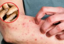 Tabasco suma tres casos humanos de gusano barrenador.