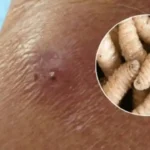 Tabasco suma siete casos de miasis por gusano barrenador.