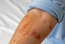 Alerta sanitaria en México por repunte acelerado de sarampión.