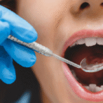 ¡Alarma dental! Seis de diez tienen caries: SETAB